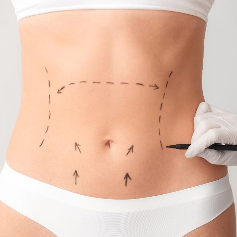 Abdominoplastia Luxxia Clinic Barcelona