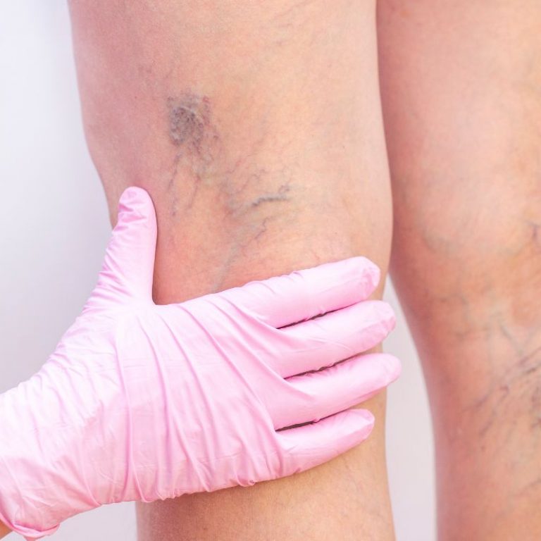 Esclerosis vascular Luxxia Clinic Barcelona