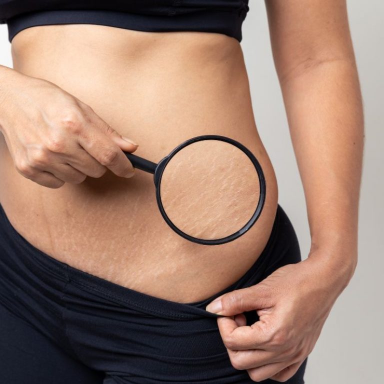 Tratamiento para estrías Luxxia Clinic Barcelona